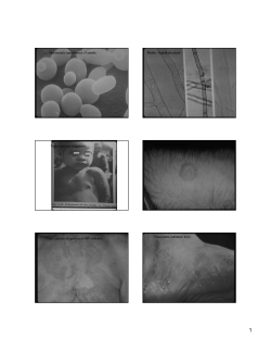 Microscopic appearance of yeasts Molds: hyphal structure Tinea