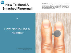 How To Mend A Smashed Fingernail How Not To Use a Hammer