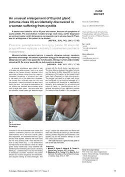 An unusual enlargement of thyroid gland (struma class III