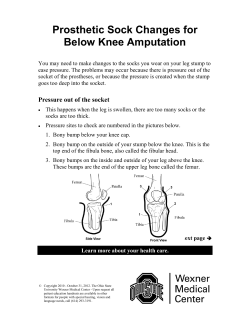 Prosthetic Sock Changes for Below Knee Amputation