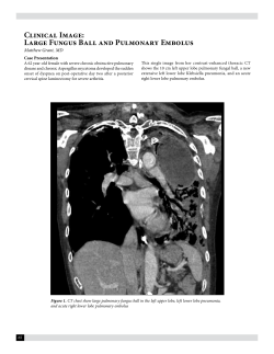 Clinical Image: Large Fungus Ball and