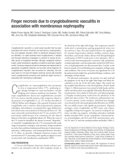 Finger necrosis due to cryoglobulinemic vasculitis