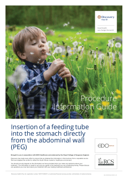E09 Insertion of a feeding tube into the stomach directly from the