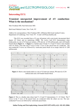 Interesting ECG Transient unexpected improvement of AV conduction