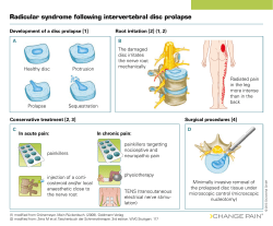 Radicular syndrome following intervertebral disc