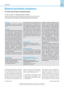 Bilateral periorbital ecchymoses