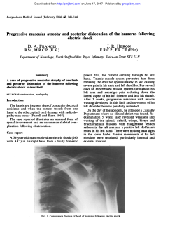 Progressive muscular atrophy and posterior dislocation of the