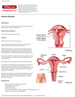 Fibroids - Scott Kramer MD