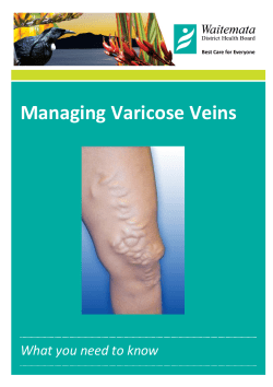 Managing Varicose Veins