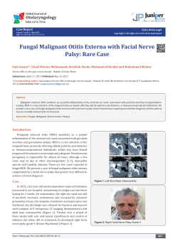 Fungal Malignant Otitis Externa with Facial Nerve Palsy: Rare Case