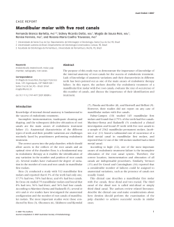 Mandibular molar with five root canals