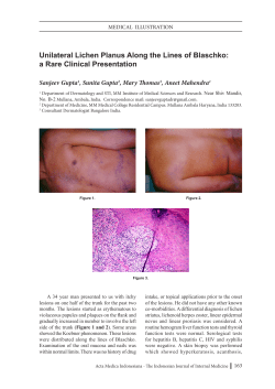Unilateral Lichen Planus Along the Lines of