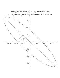 45 degree inclination, 20 degree anteversion 43 degrees=angle of