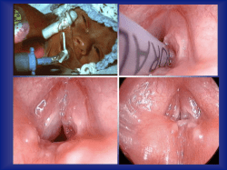 Laryngeal Reconstruction vs Cricotracheal resection