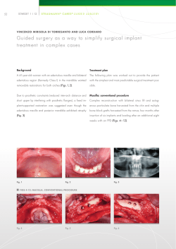 Guided surgery as a way to simplify surgical implant