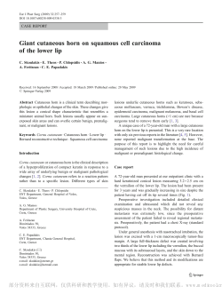 Giant cutaneous horn on squamous cell carcinoma of the lower lip