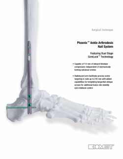 Phoenix Ankle Arthrodesis Nail System Surgical