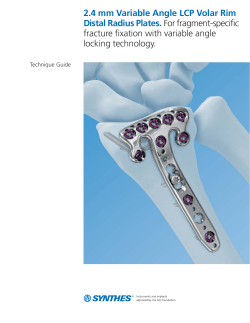 2.4 mm Variable Angle LCP Volar Rim Distal Radius Plates TG