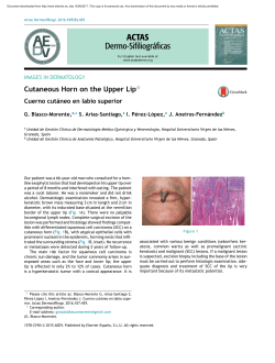 Cutaneous Horn on the Upper Lip - Actas Dermo