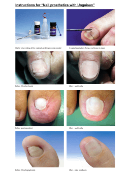 Instructions for &ldquo;Nail prosthetics with Unguisan&rdquo;