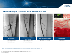 Atherectomy of Calcified 2 cm Eccentric CTO