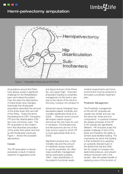 Hemi-pelvectomy amputation