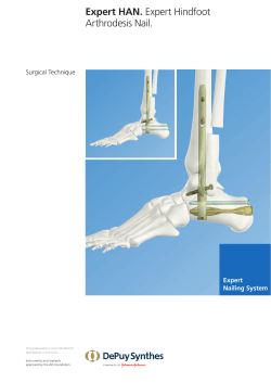 Expert HAN. Expert Hindfoot Arthrodesis Nail.