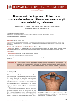 Dermoscopic findings in a collision tumor composed of a