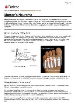 Morton`s Neuroma - Sussex MSK partnership (Central)
